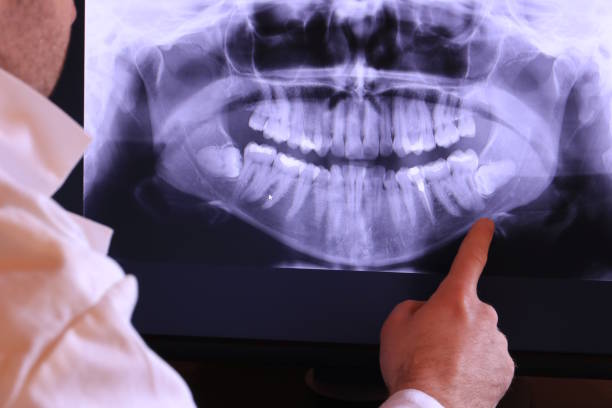 Best Emergency Tooth Extraction in Wanatah, IN