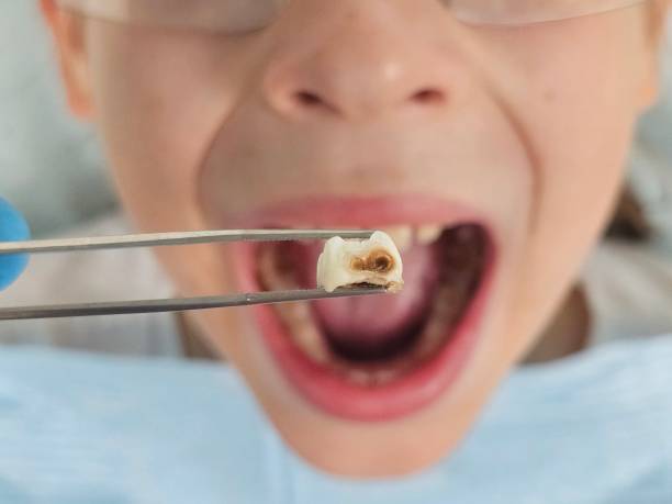 Best Emergency Root Canal Treatment in Wanatah, IN